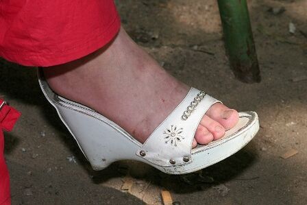 Le manque d'hygiène des pieds est la raison du développement de champignons. 
