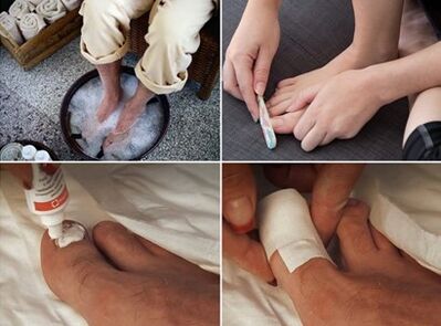 Cuire les pieds à la vapeur et appliquer de la crème à l'urée sur les ongles atteints de champignons