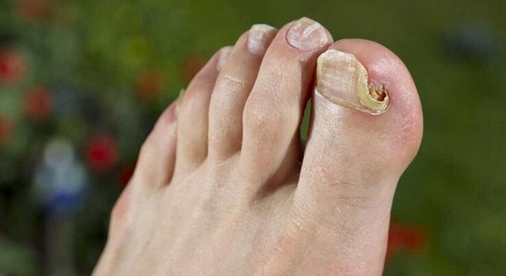 Dommages à la plaque à ongles avec des champignons sur les jambes. 
