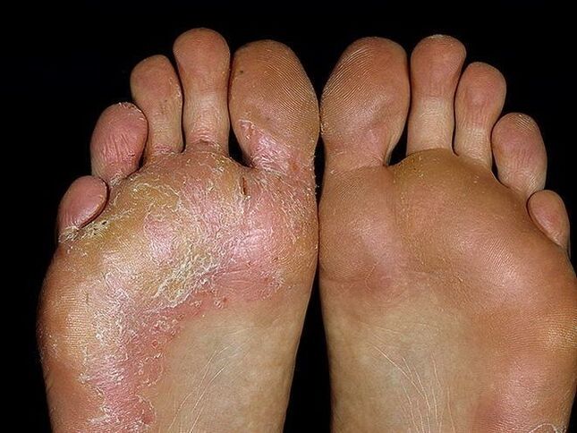 symptômes d'un champignon du pied