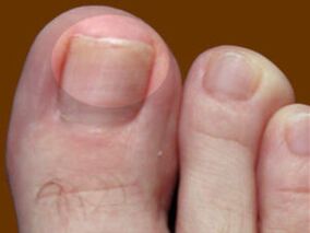 Mycose des ongles une indication pour l'utilisation de gouttes fongicides