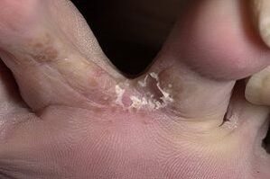 champignon sur la peau entre les orteils